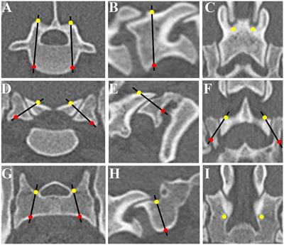 Accuracy and Efficacy of a Patient-Specific Drill Guide Template System for Lumbosacral Junction Fixation in Medium and Small Dogs: Cadaveric Study and Clinical Cases